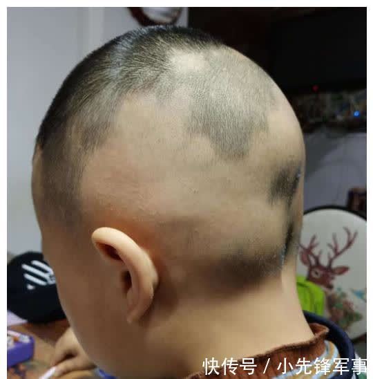 斑秃|娃的头发是发育的“标准”,发多发少家长要有数,关乎宝宝的健康
