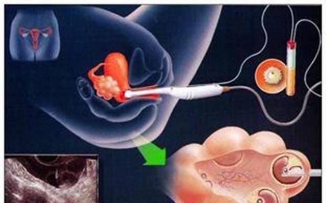 胚胎|揭秘试管婴儿全过程(附图),看完后心疼女性一万遍