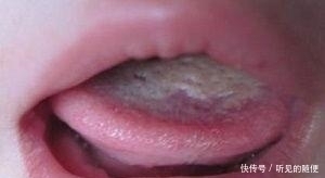 舌苔|小儿积食百病生,孩子早上出现4种表现,是脾胃在“求救”