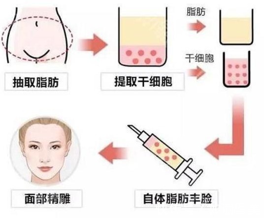 自体脂肪 自体脂肪填充术后能保持多久,会不会很快代谢掉?