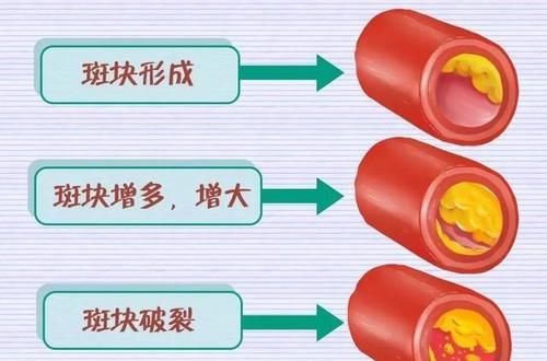 颈动脉斑块是怎么形成的，有什么好的预防方法？