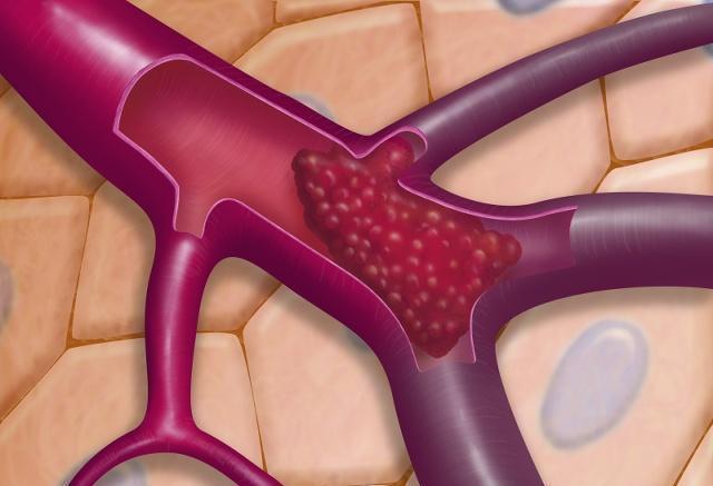 血管|血栓的“冤家”被发现了，若没事吃两口，血栓可能“不来打扰”