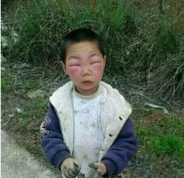 安全意识|熊孩子兄妹误捅马蜂窝,脸肿得爹妈不敢认,网友:不该笑但忍不住