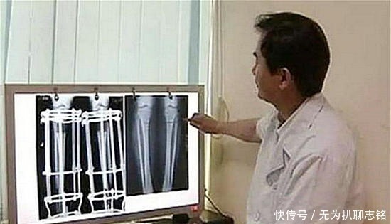 武大郎|为实现长高梦想，花16万断骨增高的李亚诺，如今过得快乐吗