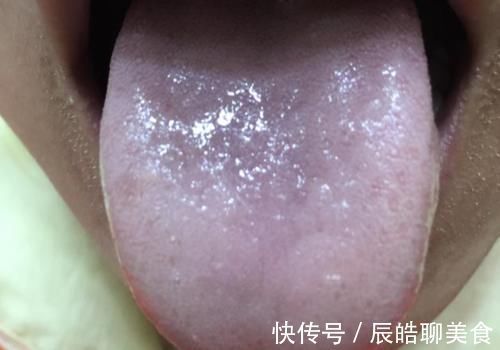 糖尿病|80后精神小伙患2型糖尿病,医生感叹太年轻,5种舌象很常见要当心