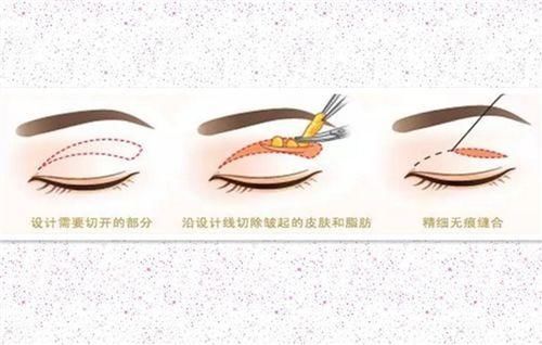 哪些人不适合双眼皮吸脂，双眼皮吸脂痛不痛？