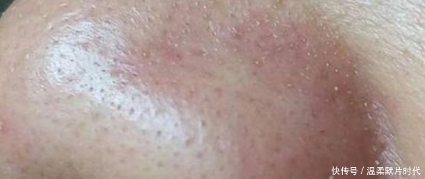 白色|你知道鼻子上挤出的“白色物体”到底是什么吗?