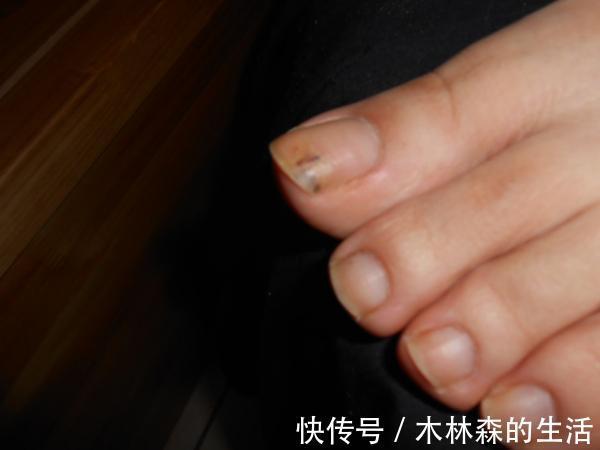 糖尿病患者|哪些人更易得灰指甲？治疗灰指甲要选对好方法！