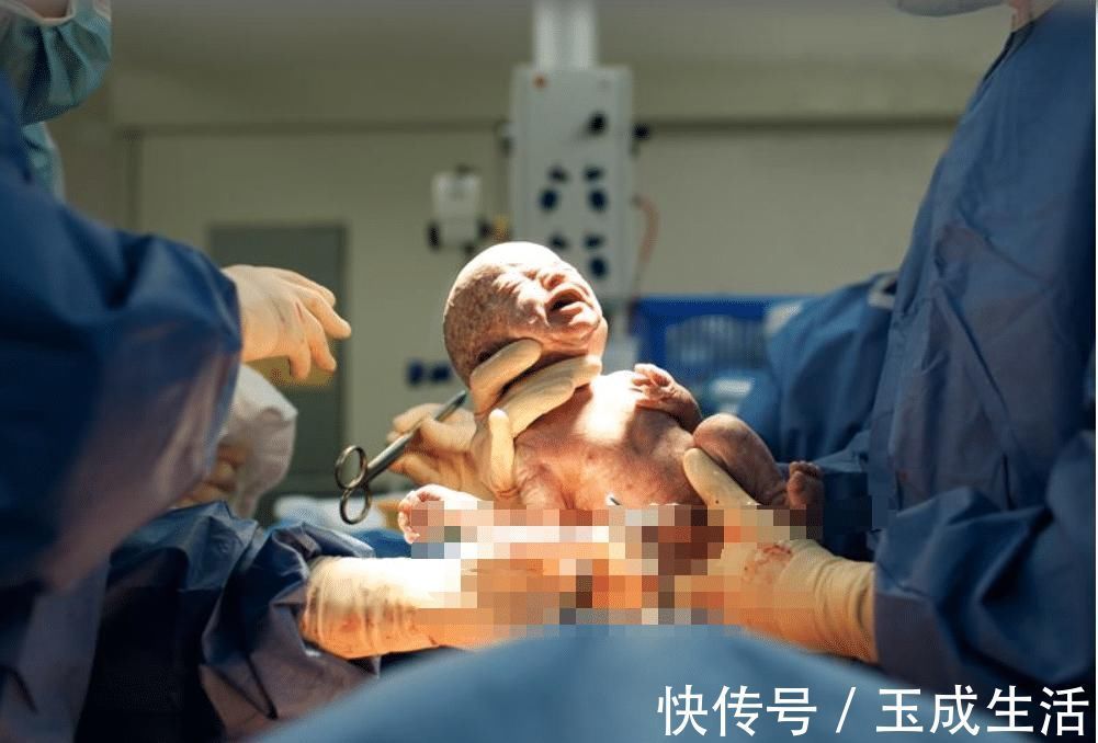 杨院长|女人可以做几次剖腹产不是三次和五次,医生不要超过这个数