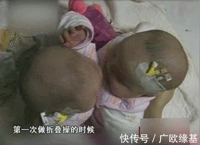 双胞胎|我国首例“坐骨连体”双胞胎，成功分开11年了，她们现在还好吗