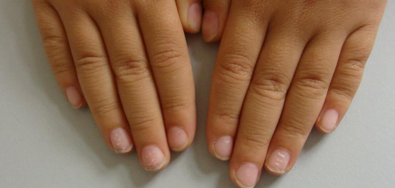 妙招|孩子指甲有白点,有寄生虫?缺维生素?都不是,跟一个坏习惯有关