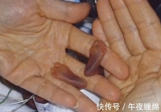 女子|女子生下3指大的婴儿,让在场所有医护人员都震惊了