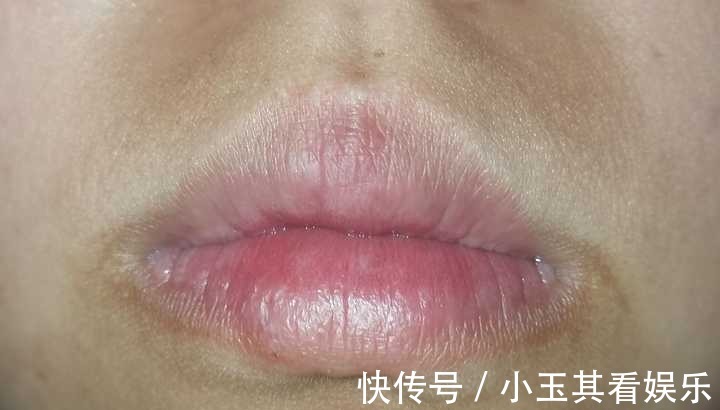美白|嘴唇周围发黑是怎么回事?如何美白呢?