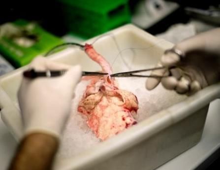 狒狒|35年前移植狒狒心脏的那个女孩，活了多久异种移植可行吗