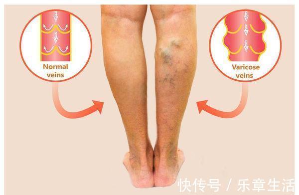 血管堵塞|脚踝处这个化血栓开关,睡前坚持打开,能清除血管垃圾,排出血栓