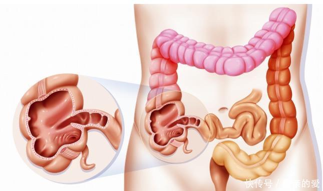 放射治疗|大肠癌会有哪些表现?如何诊断大肠癌?