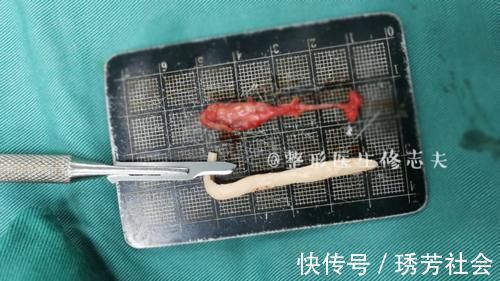 鼻尖|隆鼻后假体要定期更换吗?出现这些情形就该更换假体了!