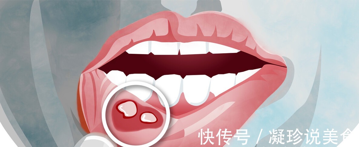 医生|女子咳嗽以为感冒,后天天咯血,医生看到鼻梁上的皮疹差点误诊