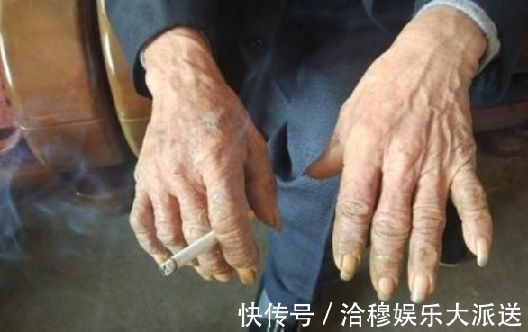 螺旋体|“性病”中最厉害的一种，接触衣物都能被感染，听听医生的忠告