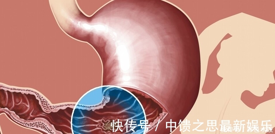 质子泵抑制剂|胃炎和幽门螺杆菌有必然联系吗,雷贝拉唑等药长期应用有何后果