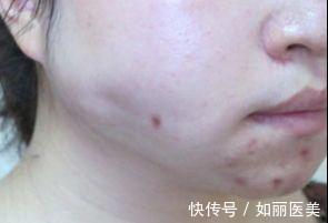 面部吸脂 面部吸脂后头套一般戴多少天?想要术后不松弛这两点要注意!