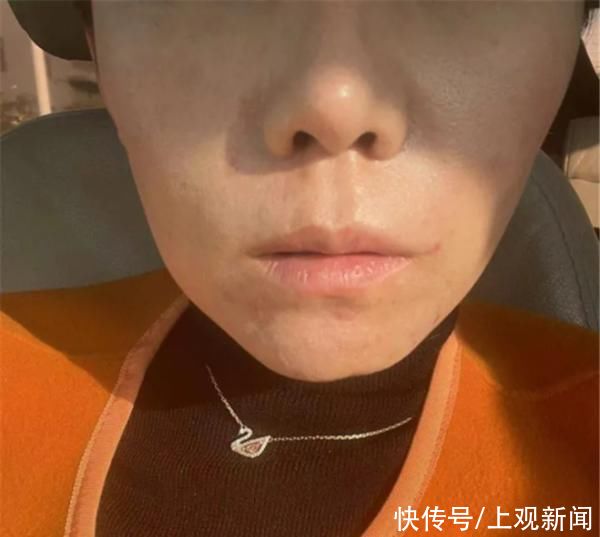 女子花2万多元整容后，感觉自己整失败：眼睛“倒三角”，看起来又凶又老，下巴歪得更厉害了