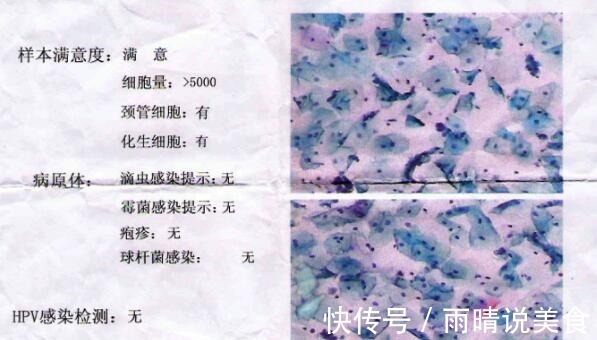 宫颈癌|32岁女子查出宫颈癌,自称没有任何疼痛感,但是2个指标要重视