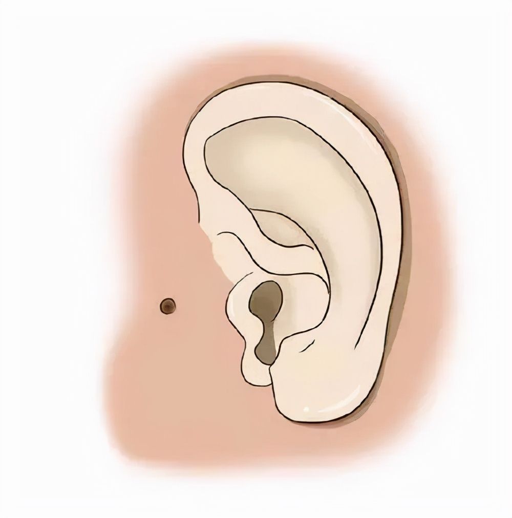 苗苗|听说耳朵长“聪明孔”,大富大贵还聪明?现实是,10岁女孩因它挨了刀