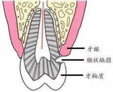 牙齿|一个刷牙好习惯，害她22颗牙全坏！可怕的是很多人每天都在做