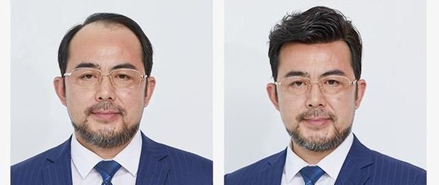 种植|天生发际线高还有救吗？试试发际线补发和自体头发种植，非常实用