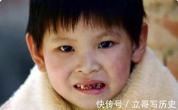 龋齿|5岁女孩满嘴小黑牙,不是糖果惹的祸,而是这种坏习惯造成的