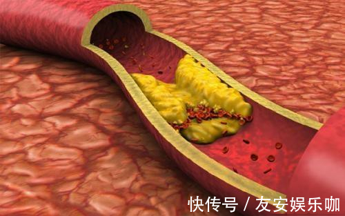 脑梗死|80岁老人,血管年龄仅有30岁!他的保养秘诀是什么?