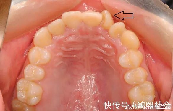 矫治|爸爸“地包天”，孩子也一样吗？医生：这7种牙齿不齐遗传性高