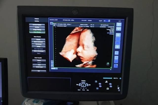 怀孕|怀孕40周B超检查全攻略，B超产检目的和注意事项，孕妈要知道