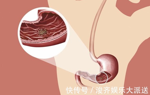 胃疼|胃癌早期不痒不疼，饭后若有4个“异常”，可能需要就医了