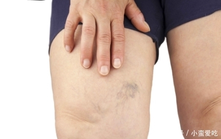 心血管|血管堵塞,身体会出现4种情况,再不注意,当心血管堵死了