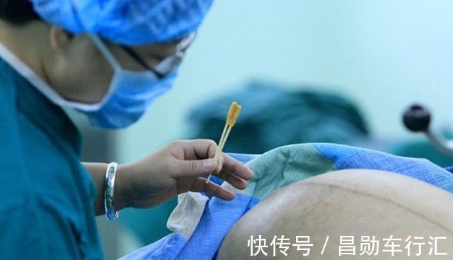 伤害|剖腹产仅是“挨一刀”?对身体伤害有多大,医生终于说了大实话!