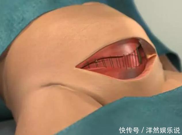 宫缩素|剖腹产仅划一刀就了事太天真!先看看用的器具,就知道女人多牛