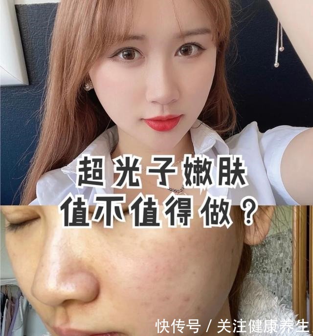 m22 超光子嫩肤真的有那么神奇吗!