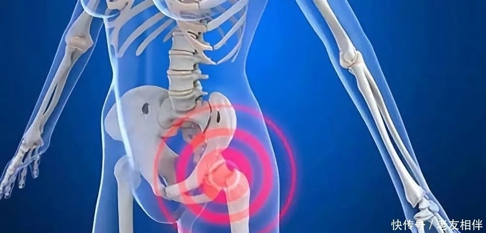要命|髋关节疼起来真要命,到底为什么这么痛?要怎么治疗?