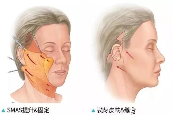 法令纹 拉皮除皱王小民教授:46岁的她选择了小拉皮手术,看看效果反馈!