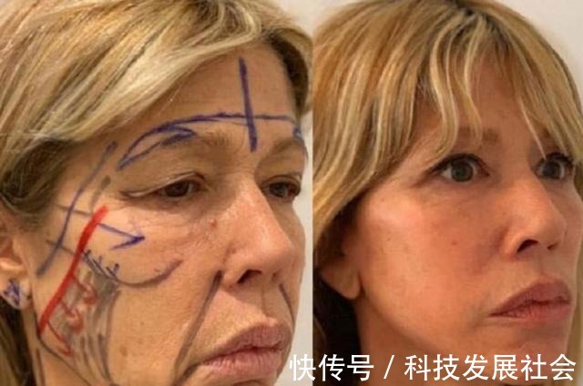筋膜 关于拉皮手术的16个真相,很多人都不知道真假!