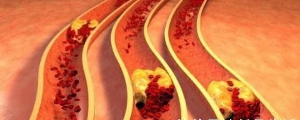 软化血管|喝什么可以预防高血压，高血脂，软化血管？今天来告诉你真相！