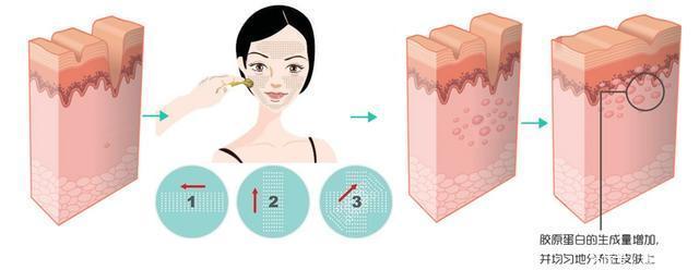 收敛毛孔,除了光子嫩肤,这两种方法也很出色