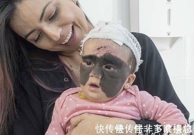 胎记|7个月婴儿脸上因巨大黑色胎记爆红!像带着“蝙蝠侠”面具!