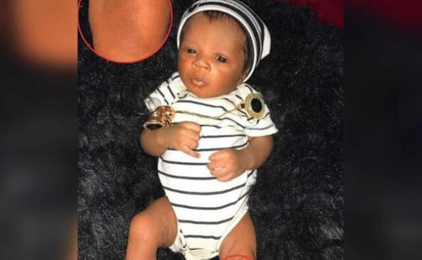 消失综合征|姐姐在腹中被弟弟“吸收”,变成胎记留弟弟腿上,网友最美胎记