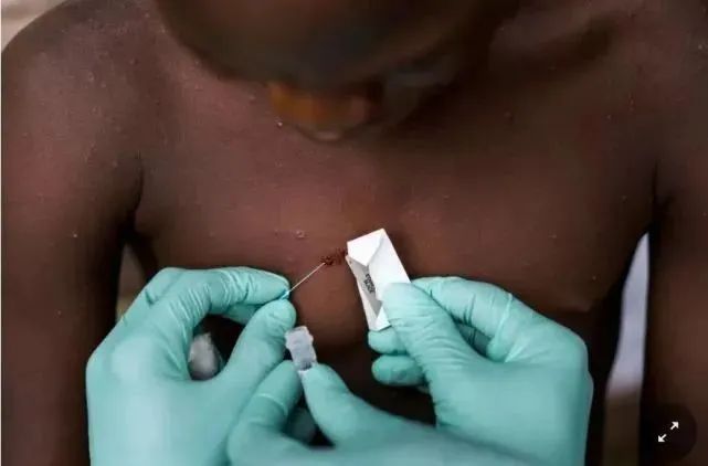 猴痘病毒|类似天花，时隔近20年美国再现这一病毒