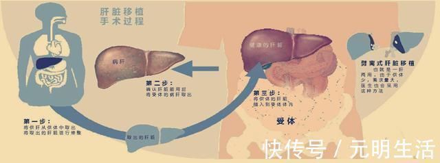 化疗|22岁妹子罹患肝癌，医生建议肝移植，妹子思考良久：不做！