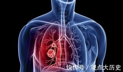 肺部|肿瘤科医生:体检时多做“这一项”检查,多数癌症能早期发现