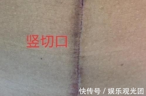 出血量|剖腹产,竖切口和横切口有什么区别?作为产妇,应该怎么选择